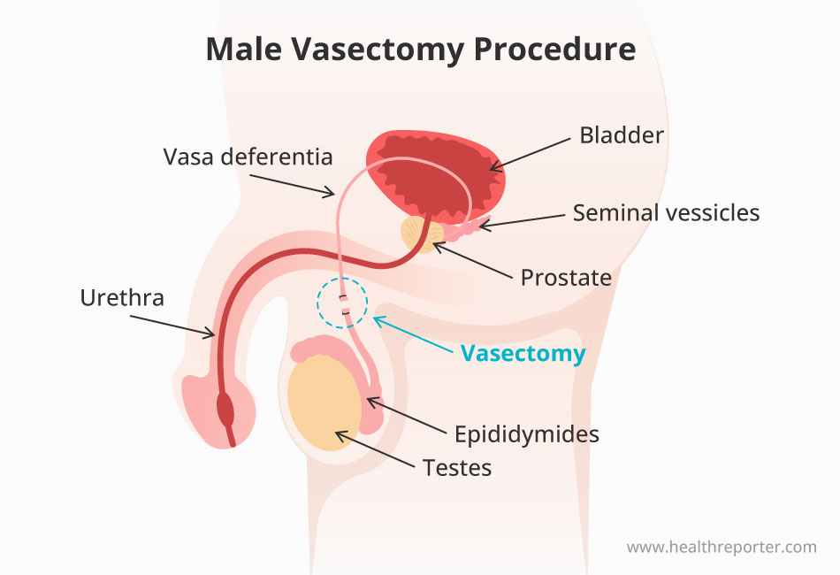 Male Vasectomy Procedure