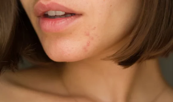 acne around mouth