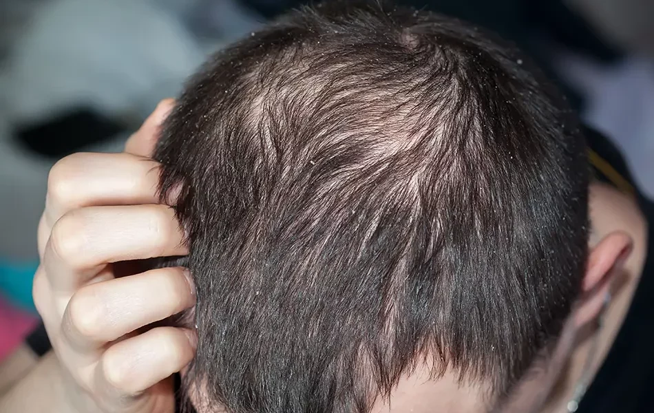 Können Schuppen Haarausfall verursachen?