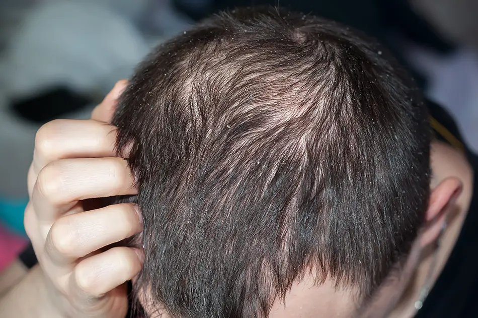 Können Schuppen Haarausfall verursachen?
