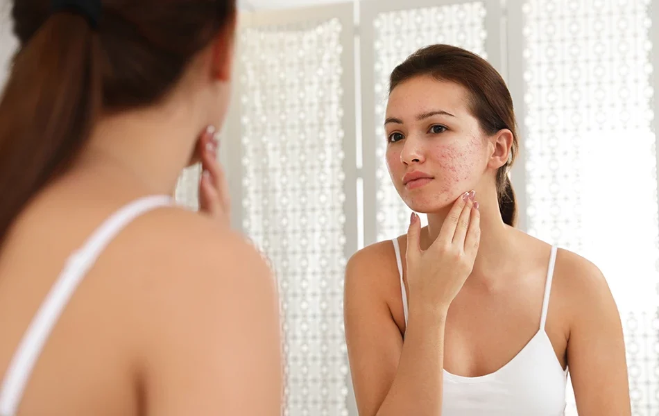 how to remove acne scars naturally